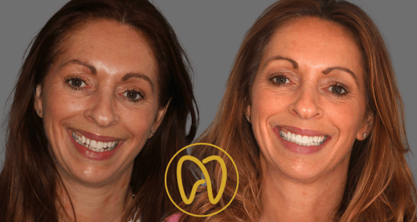 Professional teeth whitening at Forever Dental and Skin