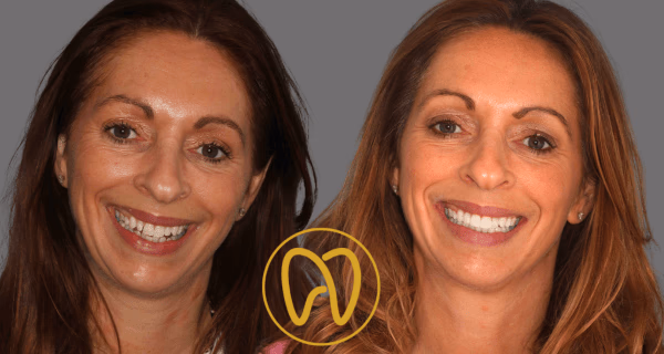 Professional teeth whitening at Forever Dental and Skin